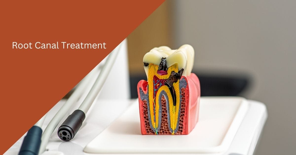 Root canal procedure diagram showing tooth structure