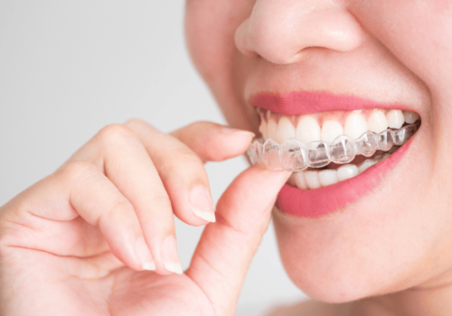 Clear Invisalign aligners for teeth straightening